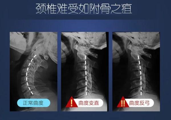 “我想拧掉脑袋！”杭州15岁学霸一刷题就头痛欲裂！医生：这个习惯太差了，家长一定要看