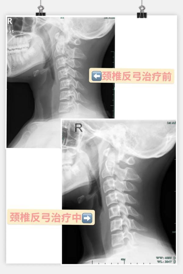 “我想拧掉脑袋！”杭州15岁学霸一刷题就头痛欲裂！医生：这个习惯太差了，家长一定要看