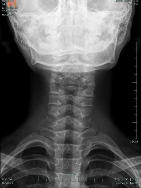 一觉醒来，杭州10岁男孩脖子“瘫”了！医生：不可逆伤害