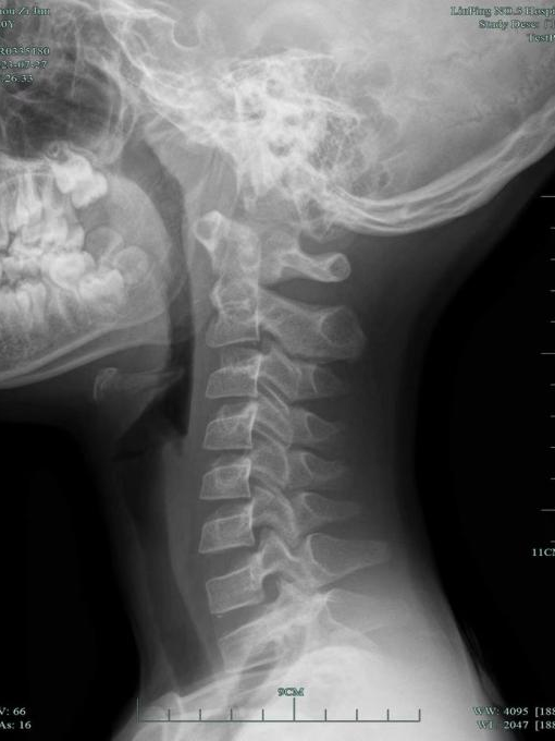 一觉醒来，杭州10岁男孩脖子“瘫”了！医生：不可逆伤害